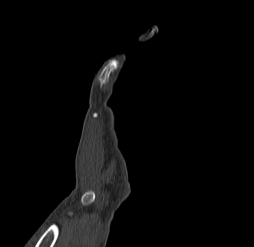 Base of 2nd metacarpal fracture (Radiopaedia 73741-84544 Coronal bone window 15).jpg