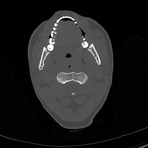 Base of skull fracture with bilateral Le Fort fractures (Radiopaedia 47094-51638 Axial bone window 5).jpg