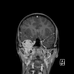 File:Base of skull rhabdomyosarcoma (Radiopaedia 32196-33142 I 31).jpg