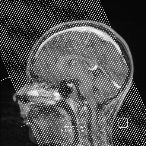Base of skull rhabdomyosarcoma (Radiopaedia 32196-33142 I 72).jpg