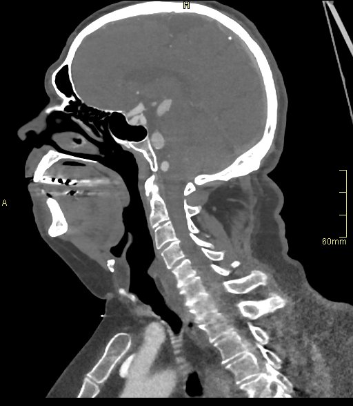 Basilar artery aneurysm (Radiopaedia 56261-62932 C 33).jpg