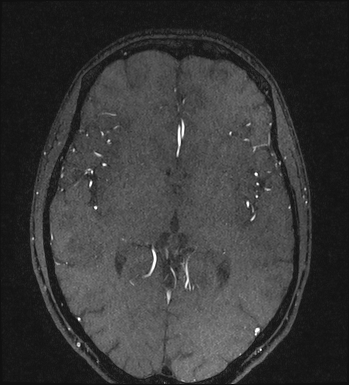 Basilar artery perforator aneurysm (Radiopaedia 82455-97733 Axial MRA 135).jpg