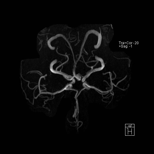 Basilar tip aneurysm (Radiopaedia 26504-26632 D 19).jpg