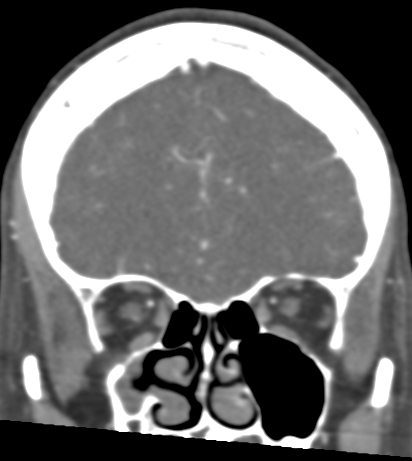 Basilar tip aneurysm with coiling (Radiopaedia 53912-60086 B 32).jpg