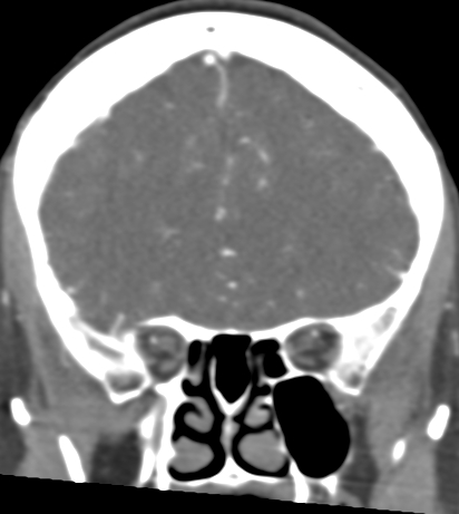 File:Basilar tip aneurysm with coiling (Radiopaedia 53912-60086 B 41).jpg