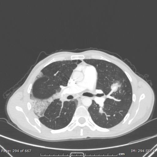 File:Behçet disease (Radiopaedia 44247-47889 Axial lung window 37).jpg