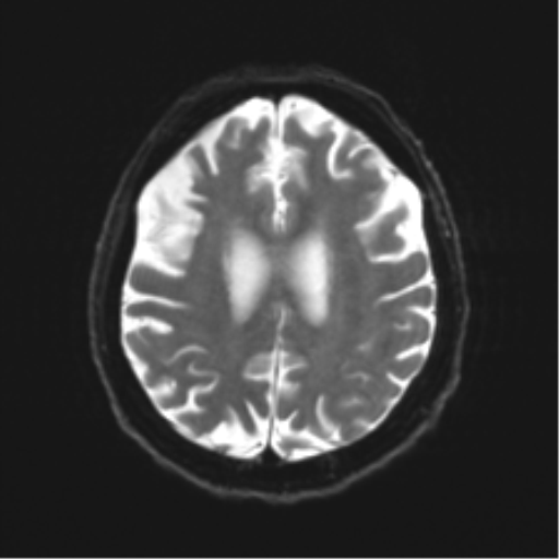 Behavioral variant frontotemporal dementia and late onset schizophrenia (Radiopaedia 52197-58083 Axial DTI Trace W 18).png