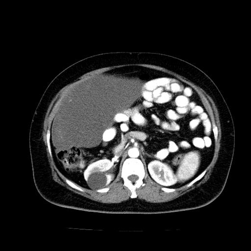 Benign spindle cell tumor - abdominopelvic (Radiopaedia 61300-69212 A 23).jpg