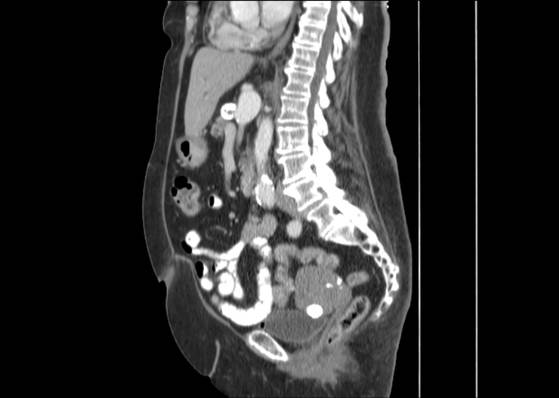 Bicameral celiacomesenteric aneurysm (Radiopaedia 55766-62327 B 29).jpg