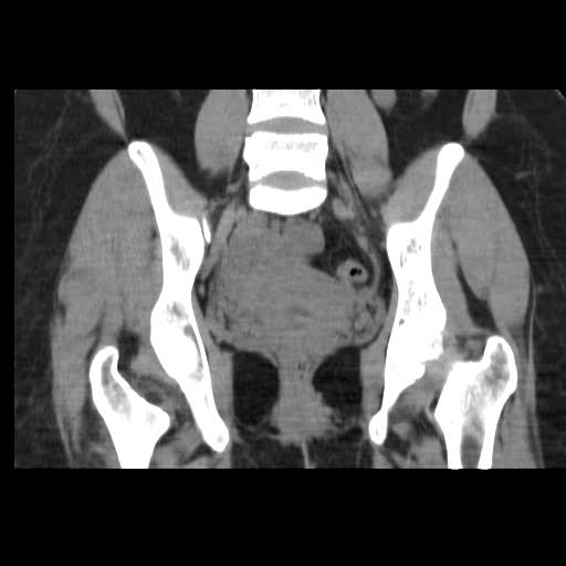 File:Bicornuate uterus- on MRI (Radiopaedia 49206-54296 Coronal non-contrast 13).jpg