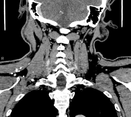 File:Bilateral Warthin tumors (Radiopaedia 84034-99263 C 39).jpg