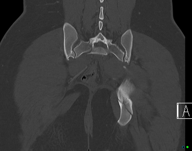 File:Bilateral acetabular fractures (Radiopaedia 79272-92308 Coronal bone window 35).jpg