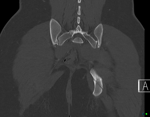 File:Bilateral acetabular fractures (Radiopaedia 79272-92308 Coronal bone window 36).jpg