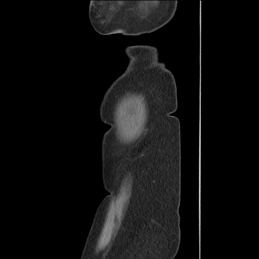 Bilateral adrenal granulocytic sarcomas (chloromas) (Radiopaedia 78375-91007 C 131).jpg