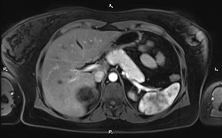 Bilateral adrenal myelolipoma (Radiopaedia 63058-71537 Axial T1 C+ fat sat 30).jpg