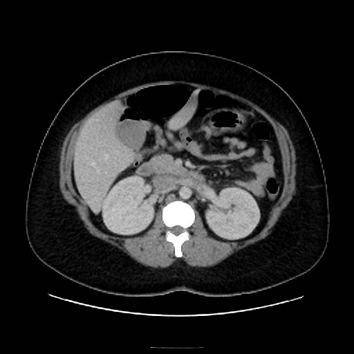 Bilateral adrenal thrombosis (Radiopaedia 58182-65256 A 28).jpg