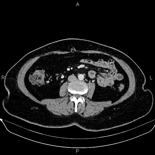 Bilateral benign adrenal adenomas (Radiopaedia 86912-103124 B 61).jpg