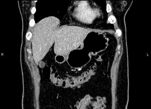 Bilateral benign adrenal adenomas (Radiopaedia 86912-103124 D 9).jpg