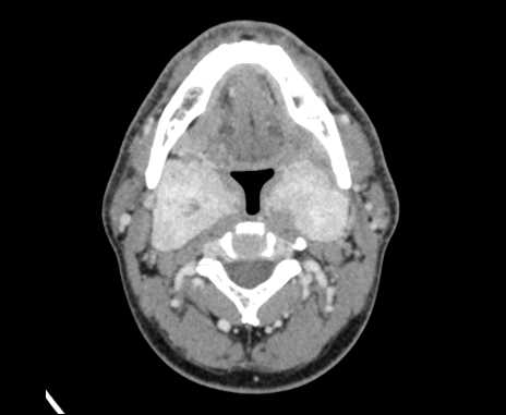 Bilateral carotid body tumors (Radiopaedia 61841-69870 Axial Post contrast 39).jpg