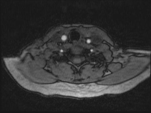 Bilateral carotid body tumors and right glomus jugulare tumor (Radiopaedia 20024-20060 Axial MRA 204).jpg