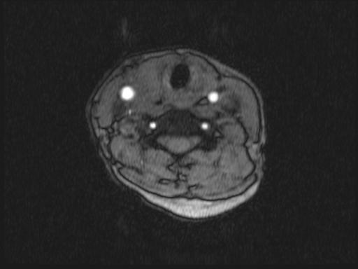 Bilateral carotid body tumors and right glomus jugulare tumor (Radiopaedia 20024-20060 Axial MRA 230).jpg