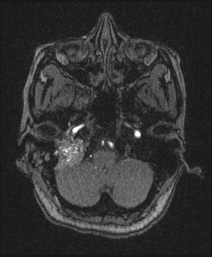 Bilateral carotid body tumors and right glomus jugulare tumor (Radiopaedia 20024-20060 Axial MRA 30).jpg
