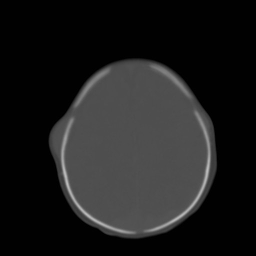 File:Bilateral cephalohematomas and subdural hematomas (Radiopaedia 26778-26929 Axial bone window 22).jpg