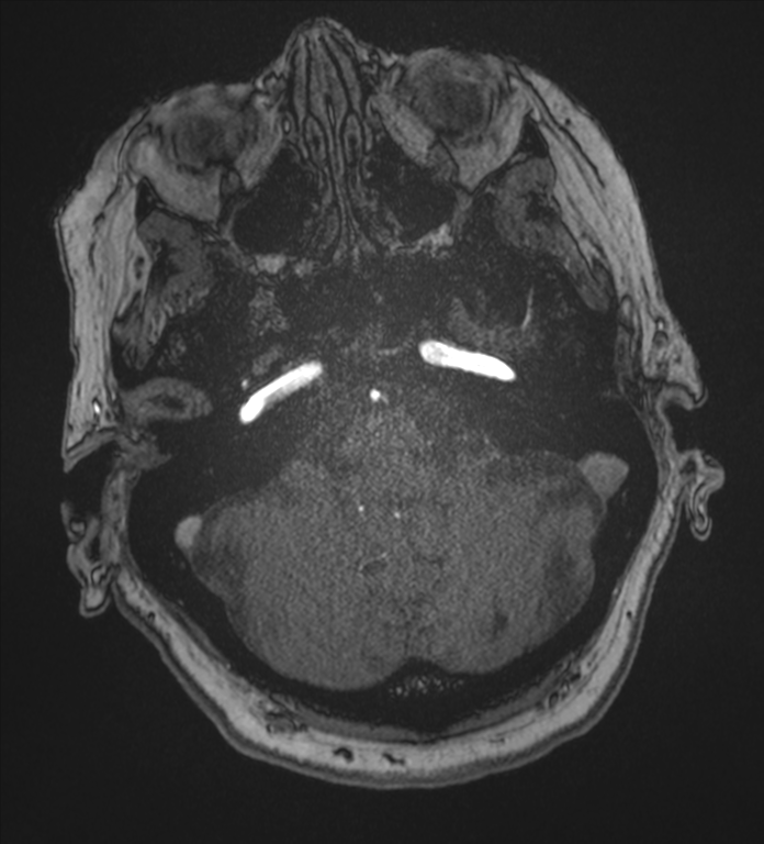 Bilateral fetal posterior communicating arteries (Radiopaedia 41286-44102 Axial MRA 32).png