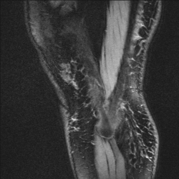Bilateral focal pigmented villonodular synovitis (Radiopaedia 67643-77073 Sagittal T1 vibe 5).jpg