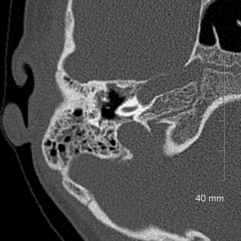 Bilateral grommets (Radiopaedia 47710-52404 Axial bone window 32).jpg