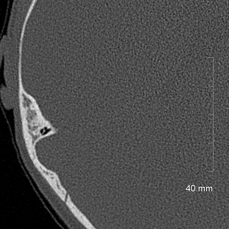 Bilateral grommets (Radiopaedia 47710-52404 Axial bone window 66).jpg