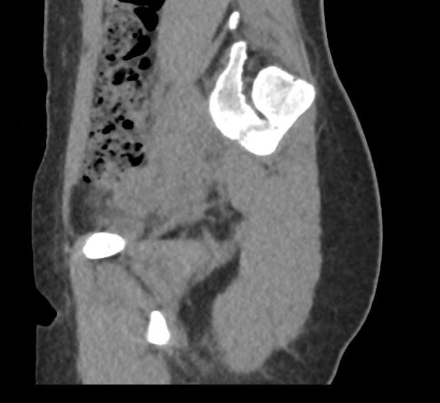 Bilateral mature cystic ovarian teratoma (Radiopaedia 88821-105592 D 9).jpg
