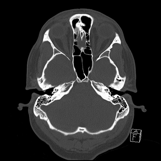 Bilateral occipital condyle fracture (type 2) (Radiopaedia 87675-104089 Axial bone window 29).jpg
