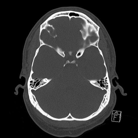 Bilateral occipital condyle fracture (type 2) (Radiopaedia 87675-104089 Axial bone window 41).jpg