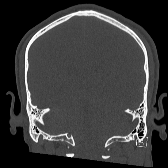 Bilateral occipital condyle fracture (type 2) (Radiopaedia 87675-104089 Coronal bone window 93).jpg