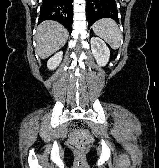 Bilateral ovarian dermoid cysts (Radiopaedia 85785-101603 C 47).jpg