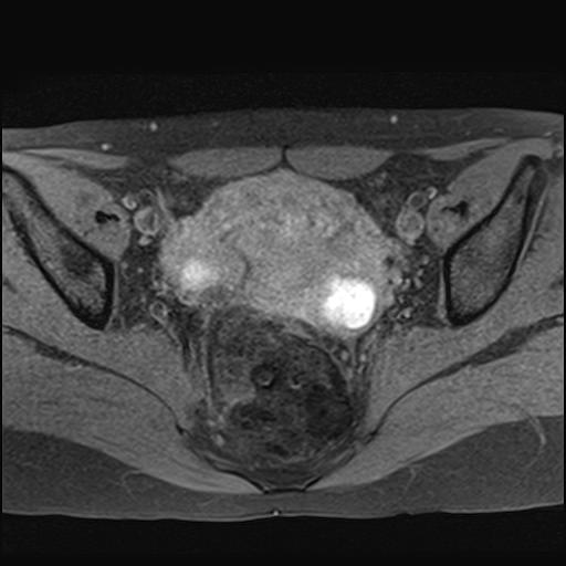 File:Bilateral ovarian endometriomas (Radiopaedia 87085-103347 Axial T1 fat sat 11).jpg