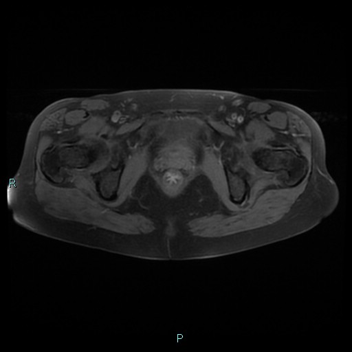 File:Bilateral ovarian fibroma (Radiopaedia 44568-48293 Axial T1 fat sat 24).jpg