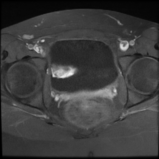 File:Bilateral ovarian fibrothecomas - adolescent (Radiopaedia 86604-102707 Axial T1 C+ fat sat 22).jpg