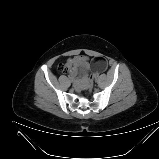 File:Bilateral ovarian mature cystic teratomas (Radiopaedia 79373-92457 Axial non-contrast 55).jpg