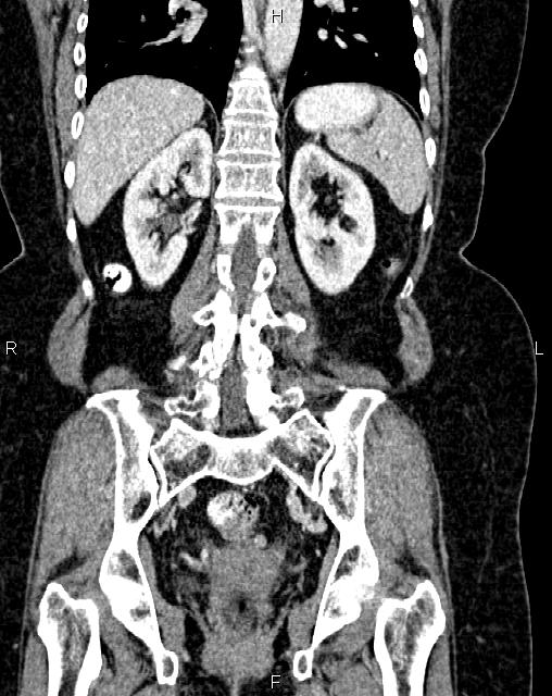 Bilateral ovarian serous cystadenocarcinoma (Radiopaedia 86062-101989 D 35).jpg