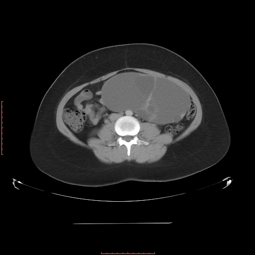 File:Bilateral ovarian serous cystadenocarcinoma with right ovarian torsion (Radiopaedia 32640-33611 A 23).jpg