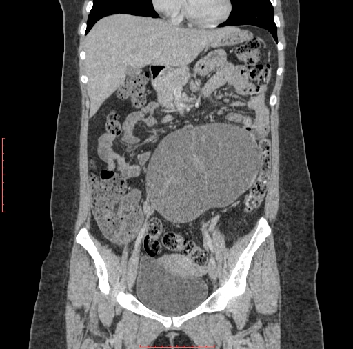File:Bilateral ovarian serous cystadenocarcinoma with right ovarian torsion (Radiopaedia 32640-33611 B 15).jpg