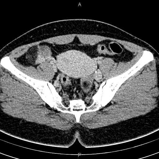 File:Bilateral ovarian teratoma (Radiopaedia 83131-97503 B 33).jpg
