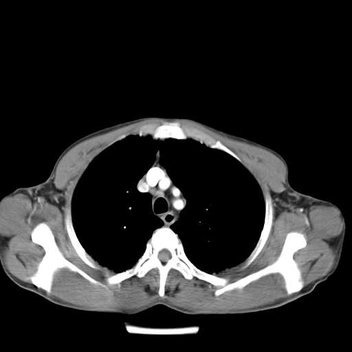 Bilateral parotid gland lymphoma (Radiopaedia 21038-20969 A 26).jpg