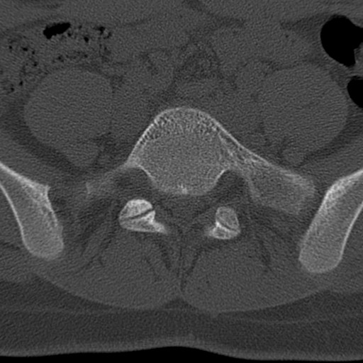 File:Bilateral pars defect (Radiopaedia 26691-26846 Axial bone window 63).jpg