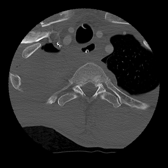 Bilateral perched facets with cord injury (Radiopaedia 45587-49713 Axial bone window 109).jpg