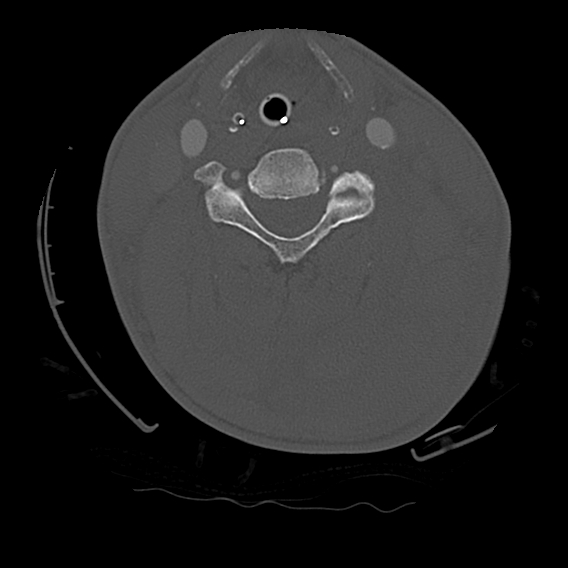 File:Bilateral perched facets with cord injury (Radiopaedia 45587-49713 Axial bone window 59).jpg