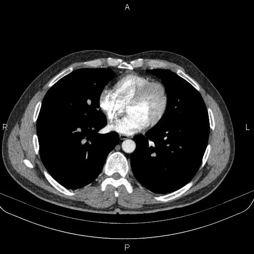 Bilateral pulmonary AVM (Radiopaedia 83134-97505 A 45).jpg