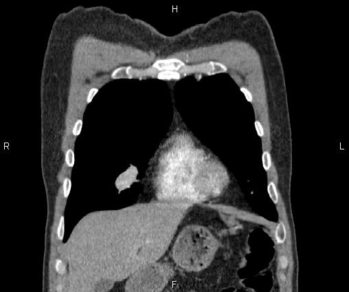 Bilateral pulmonary AVM (Radiopaedia 83134-97505 C 18).jpg